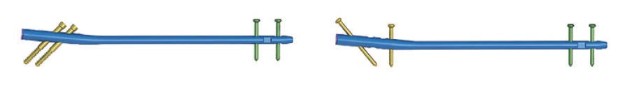 Стрижень стегновий Jinlu